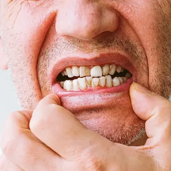 Dispositivo bucal de luz roja Glokore OralCare Plus