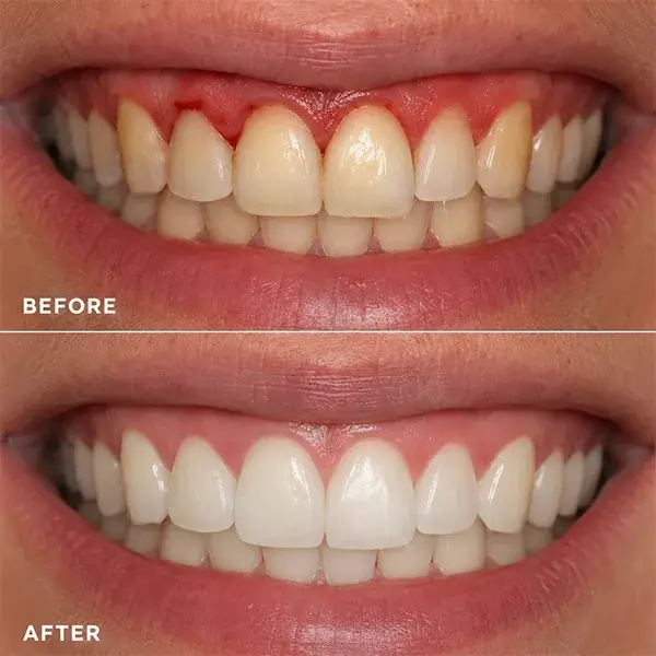 Before and after gum health results with the Glokore OralCare Plus