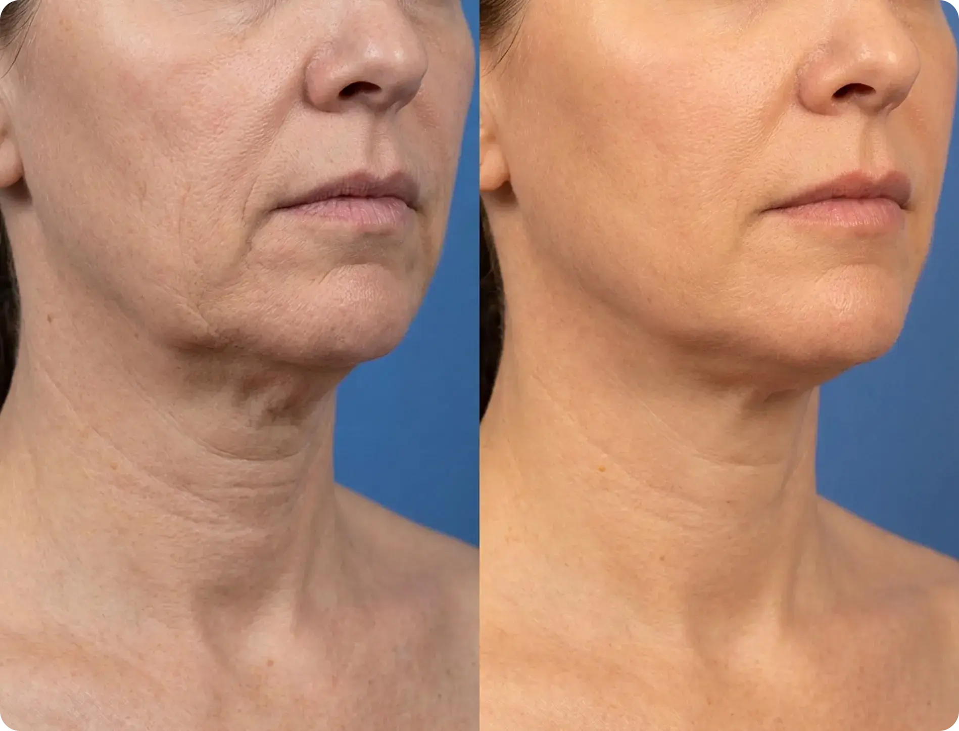 MyoGlow results — before-and-after visual