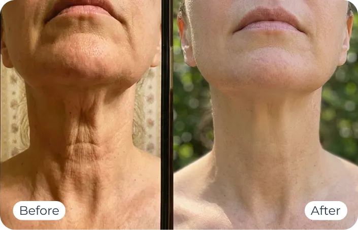 MyoGlow results — before-and-after visual