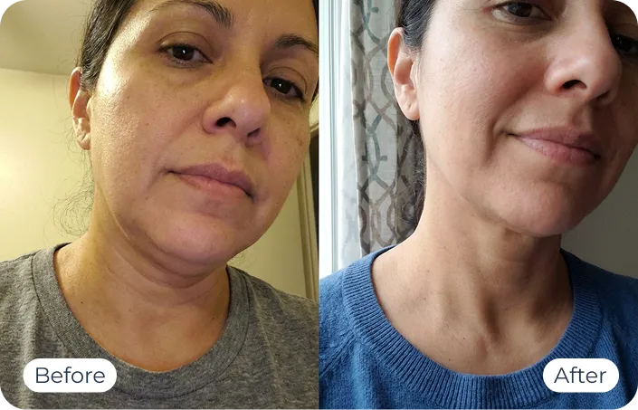 MyoGlow results — before-and-after visual