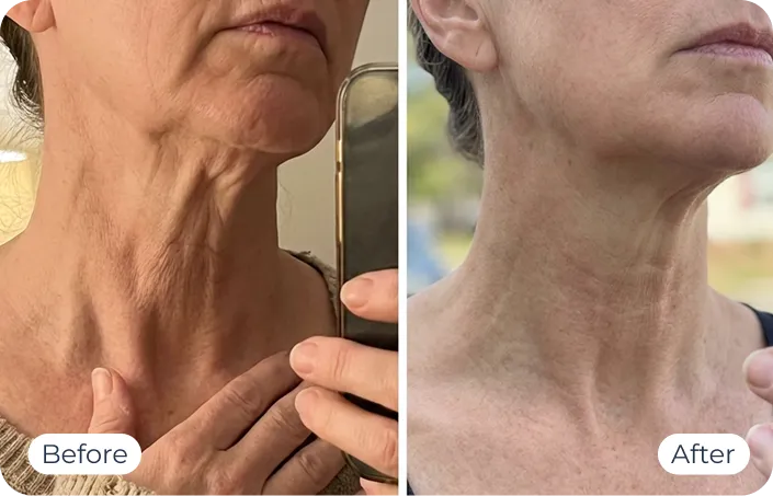 MyoGlow results — before-and-after visual