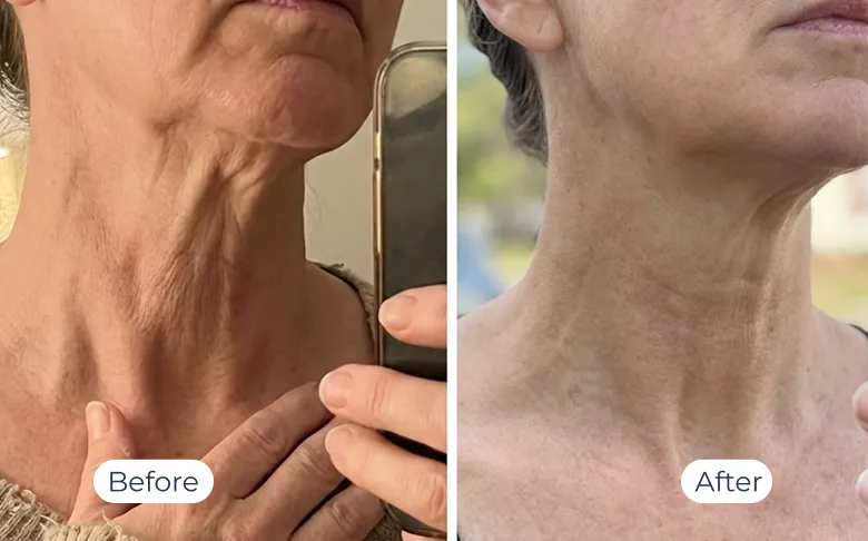 MyoGlow results — before-and-after visual