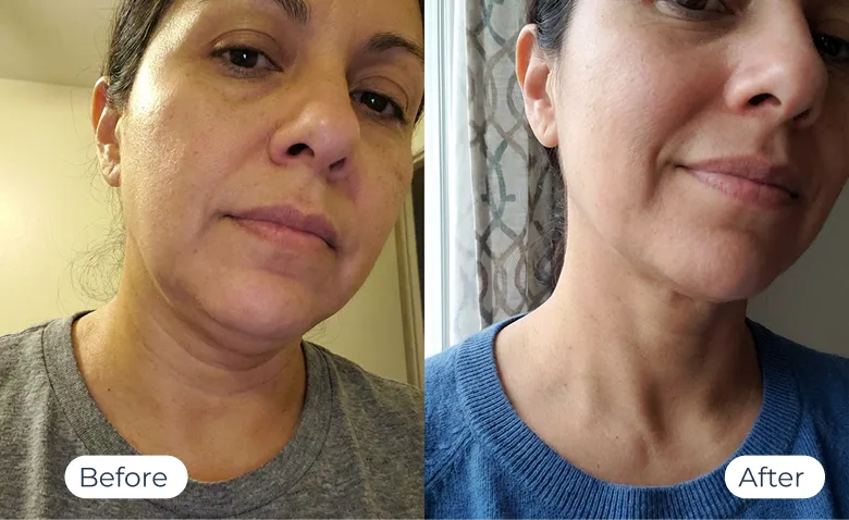 MyoGlow results — before-and-after visual