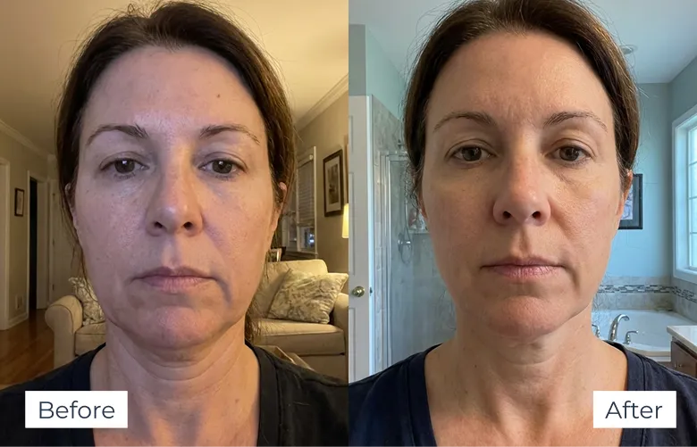 MyoGlow results — before-and-after visual