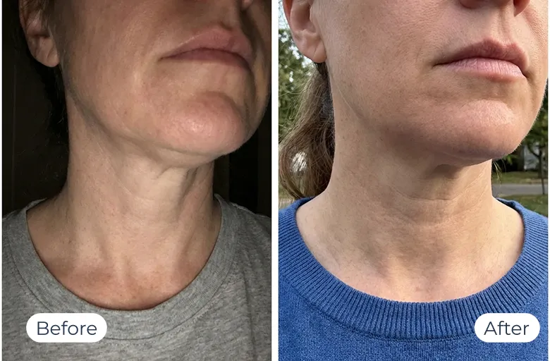MyoGlow results — before-and-after visual