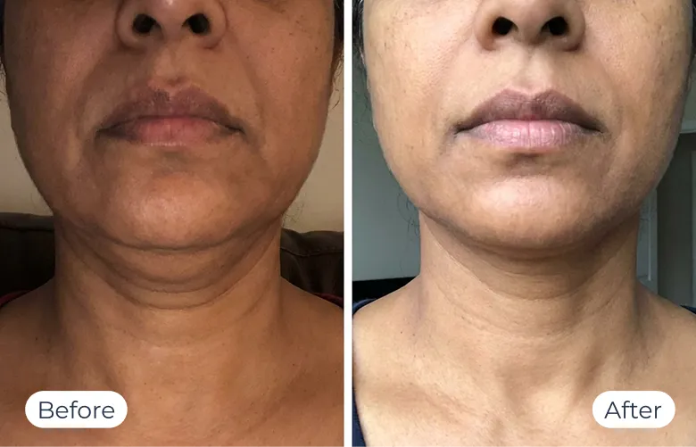 MyoGlow results — before-and-after visual